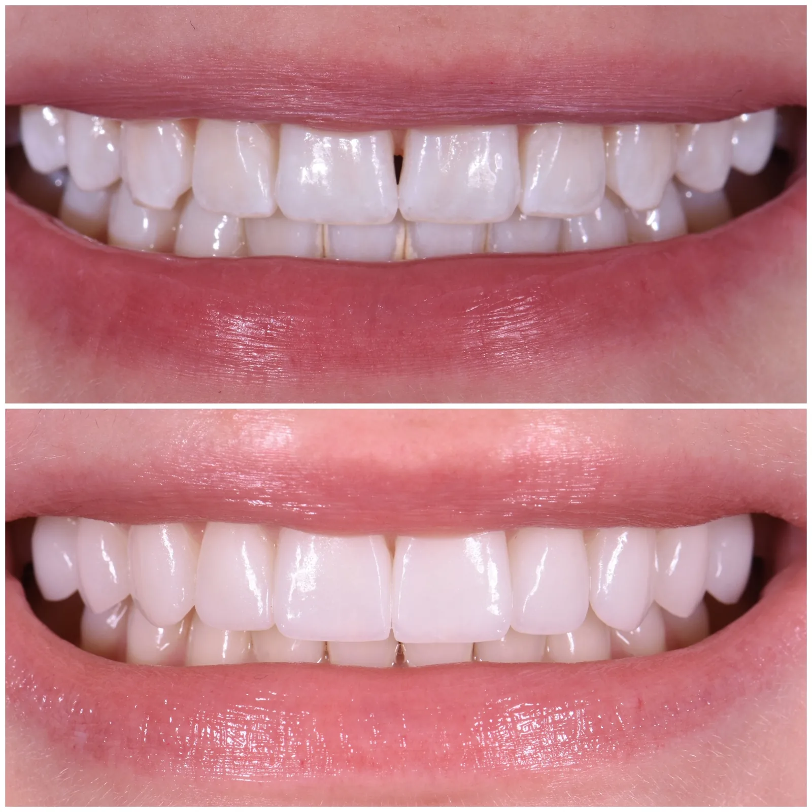 Ava, no-prep porcelain veneers, before and after