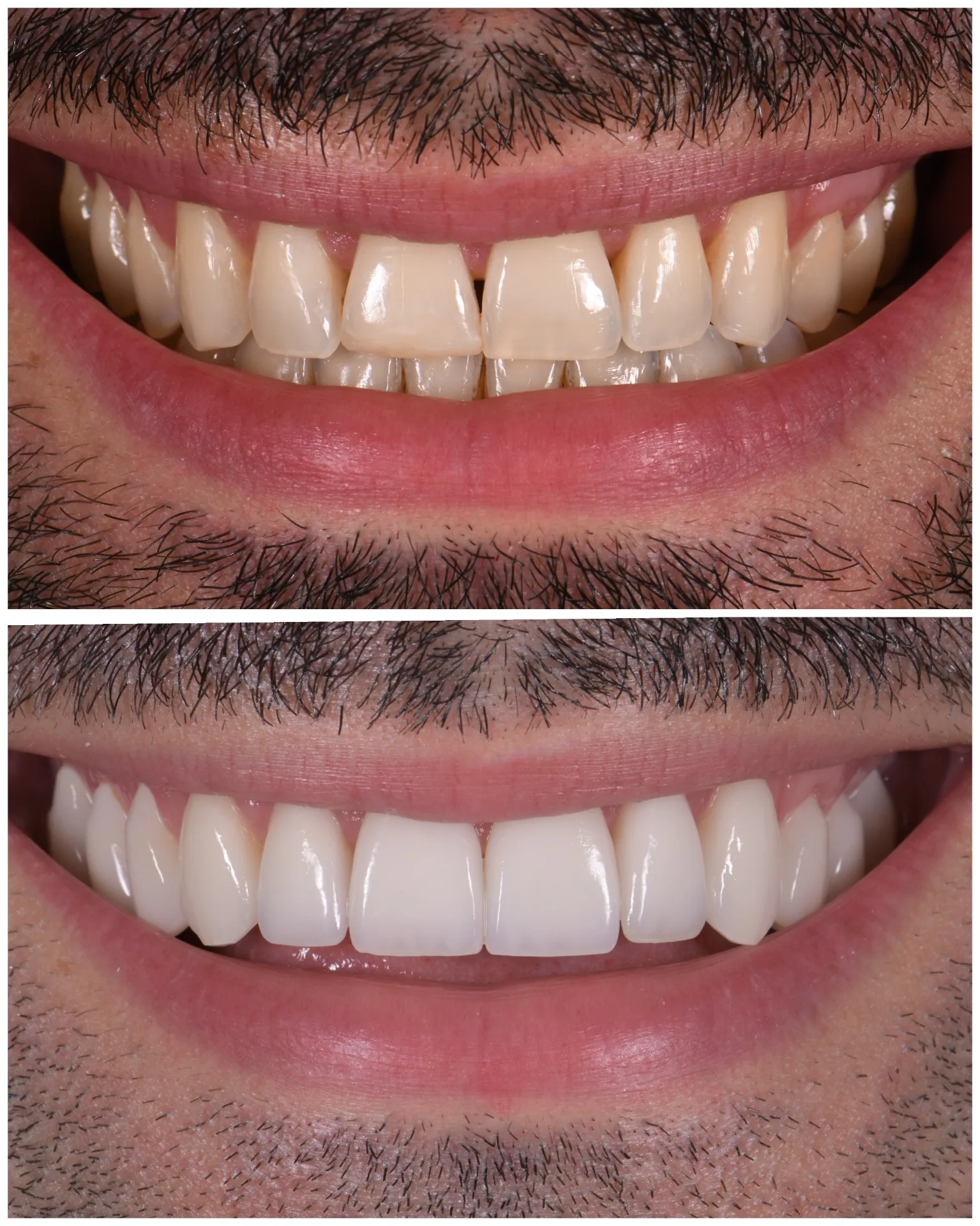 Mourad, no-prep porcelain veneers, before and after