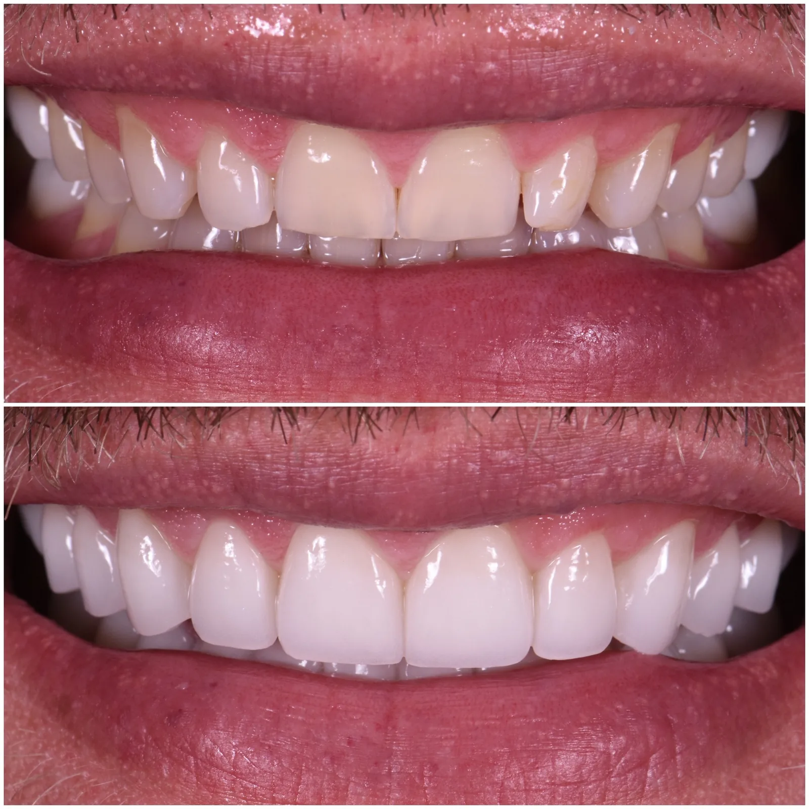 Todd, no-prep porcelain veneers, before and after