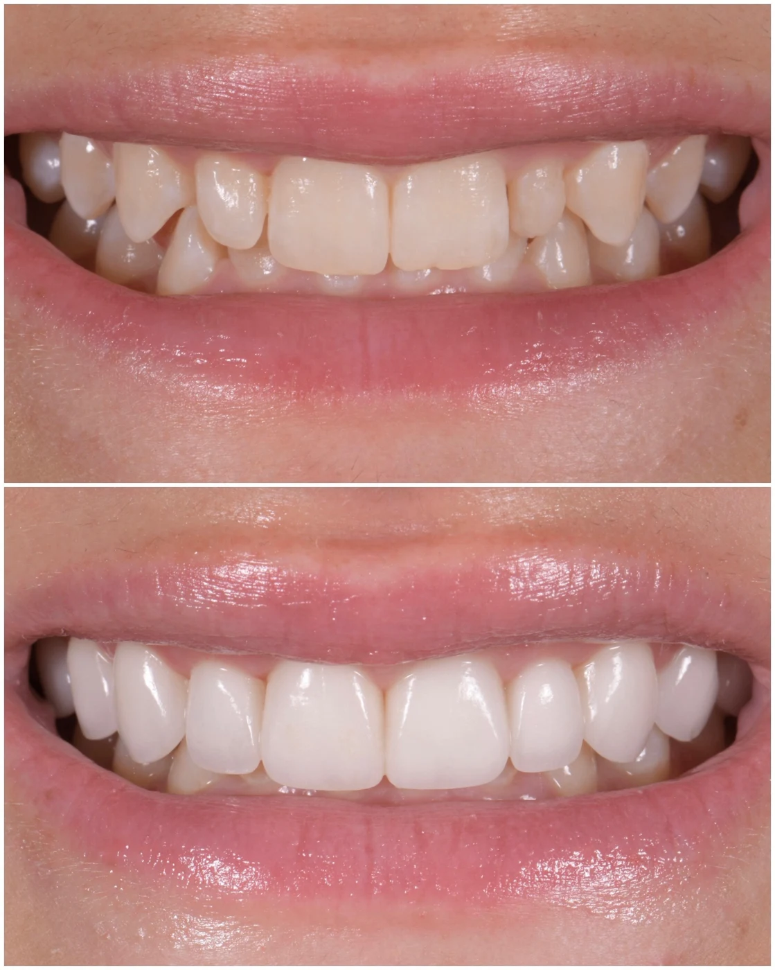 Zoe, no-prep porcelain veneers, before and after
