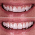 A woman's teeth before and after dental veneers.