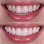 A woman's teeth before and after teeth whitening.