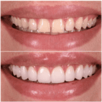 A woman's teeth before and after teeth whitening.