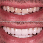 A man's teeth before and after teeth whitening.