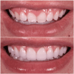 A woman's teeth before and after teeth whitening.