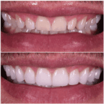 A man's teeth before and after teeth whitening.